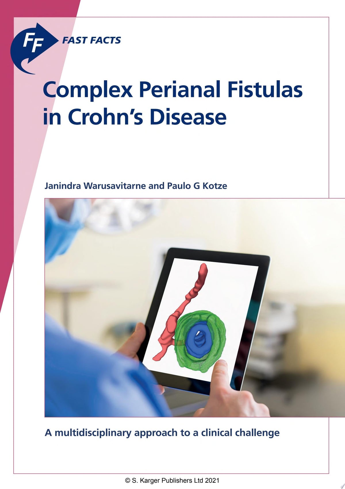 Fast Facts: Complex Perianal Fistulas in Crohn's Disease